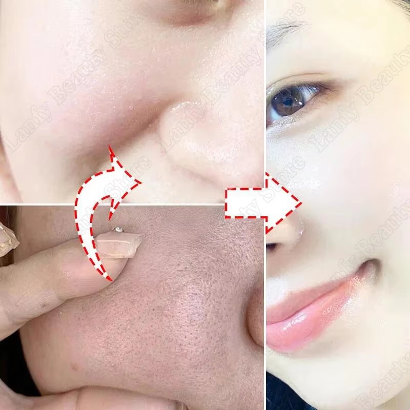 Crema Purificante con Acido Sa - Salicylic Acid Blackhead Remover recensione e prezzo