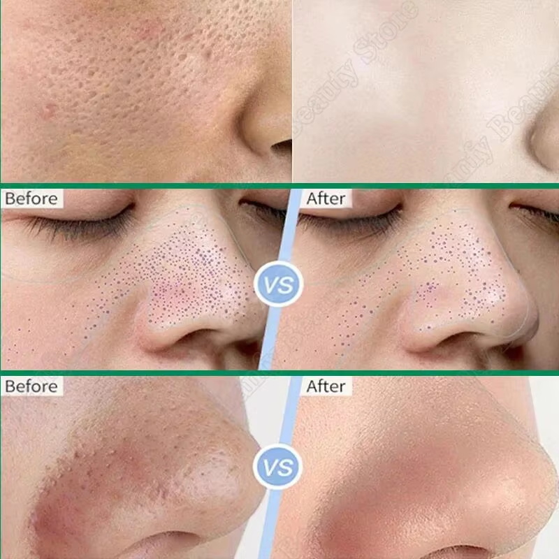 Crema Purificante con Acido Sa - Salicylic Acid Blackhead Remover recensione e prezzo